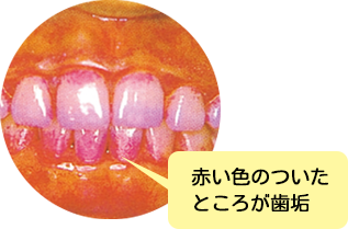 赤い色のついたところが歯垢